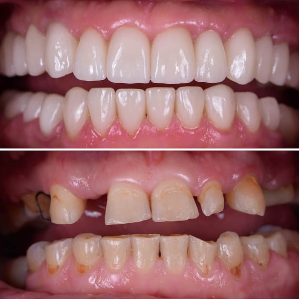 Full Mouth Rehablitatiom 1