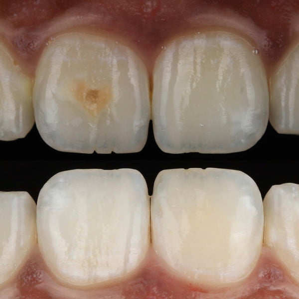 icon resin infiltration