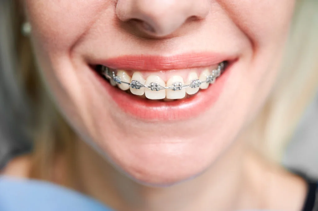 Rawatan braces Dentalane
