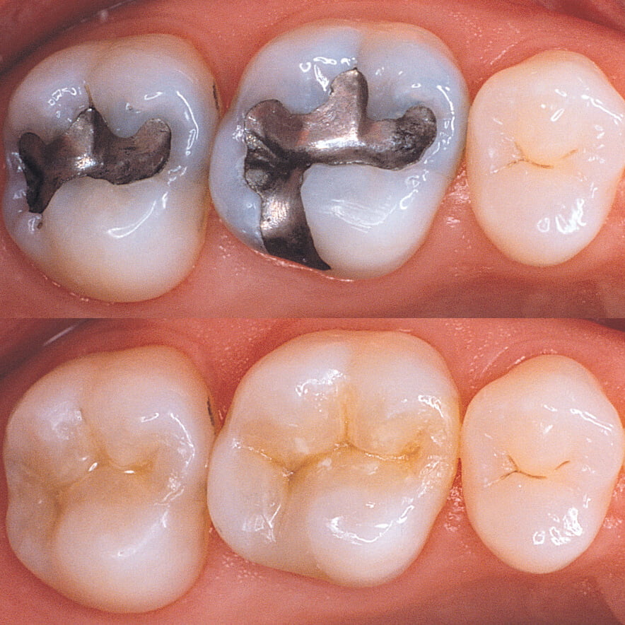 tooth fillings Filling Before After NYC