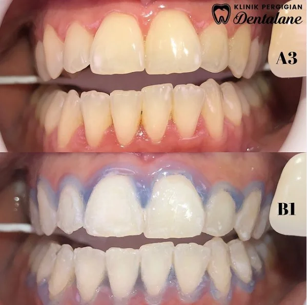Gigi sebelum dan selepas whitening, kes 2