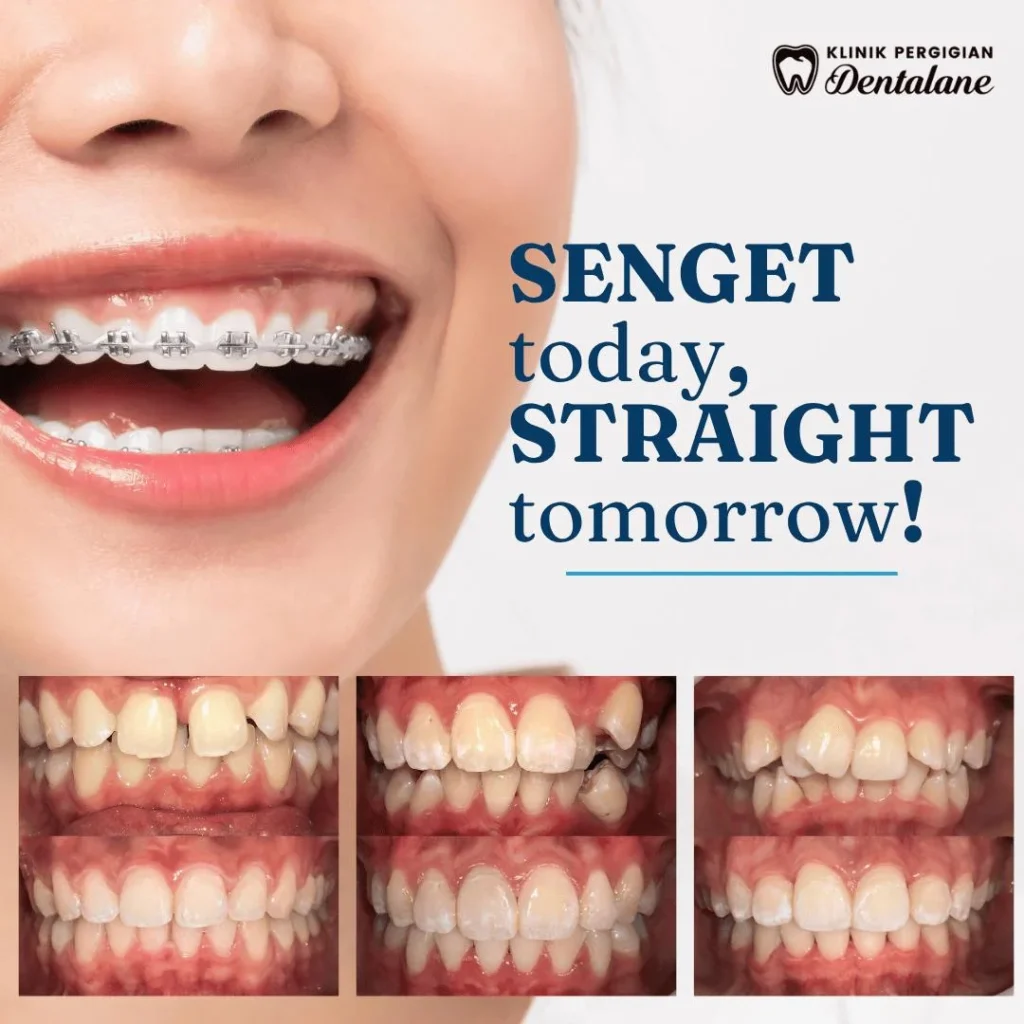 Clear Aligner dentalane