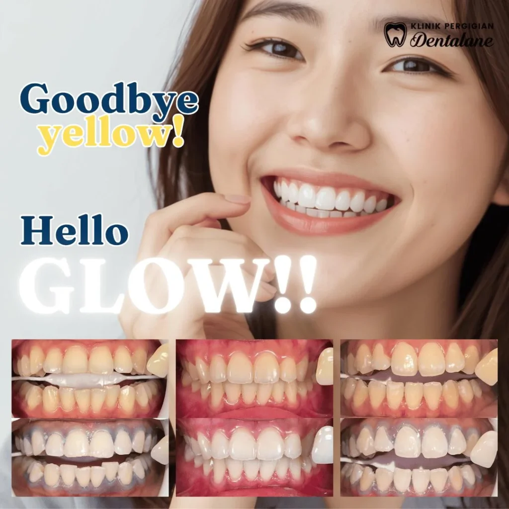 Whitening dentalane