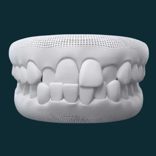 Crossbite