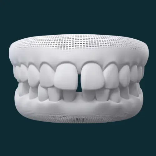 Open bite