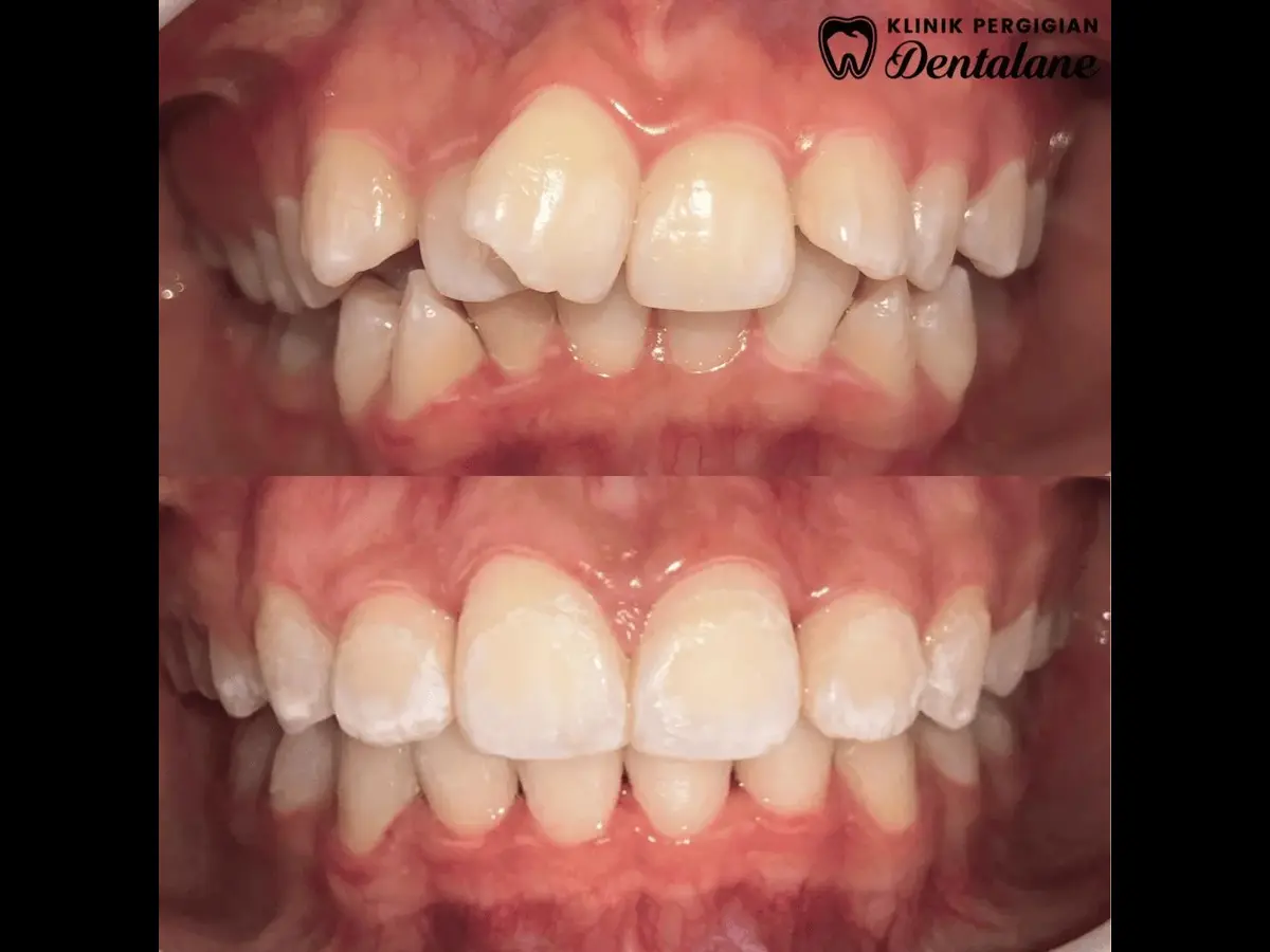 Hasil rawatan braces