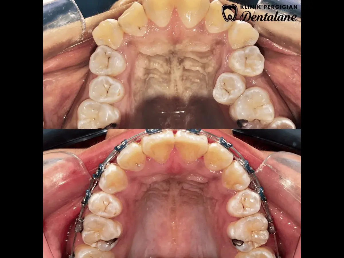 Hasil rawatan braces