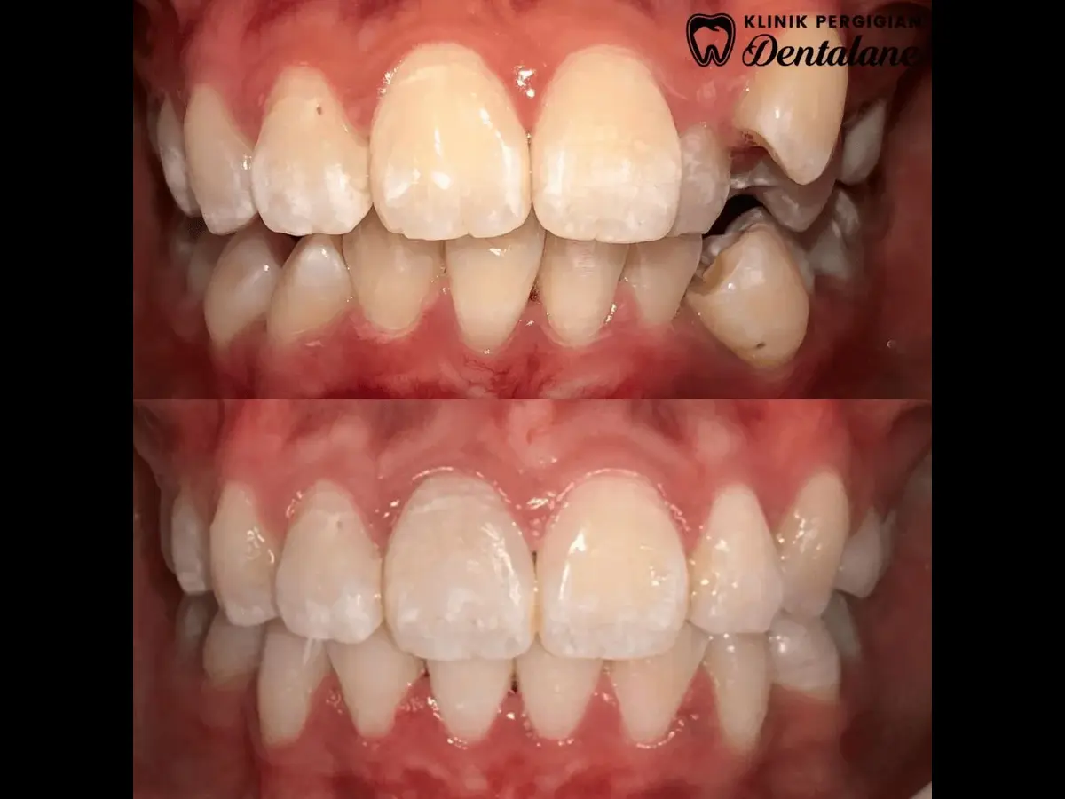 Hasil rawatan braces