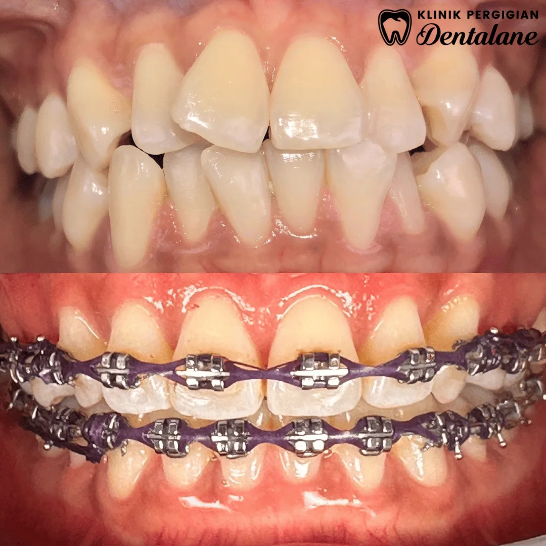 Hasil rawatan braces 4