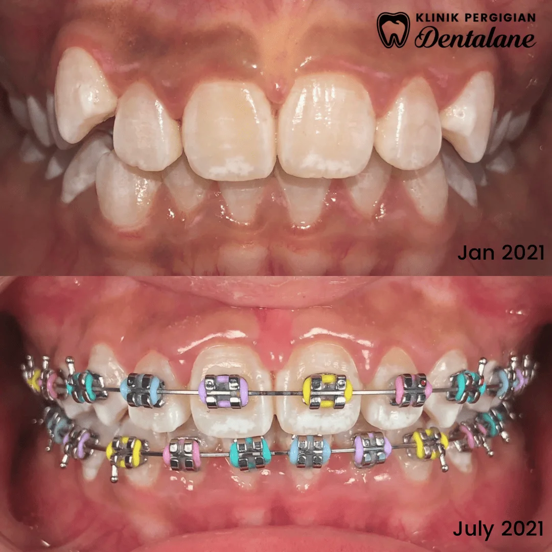 Hasil rawatan braces 5