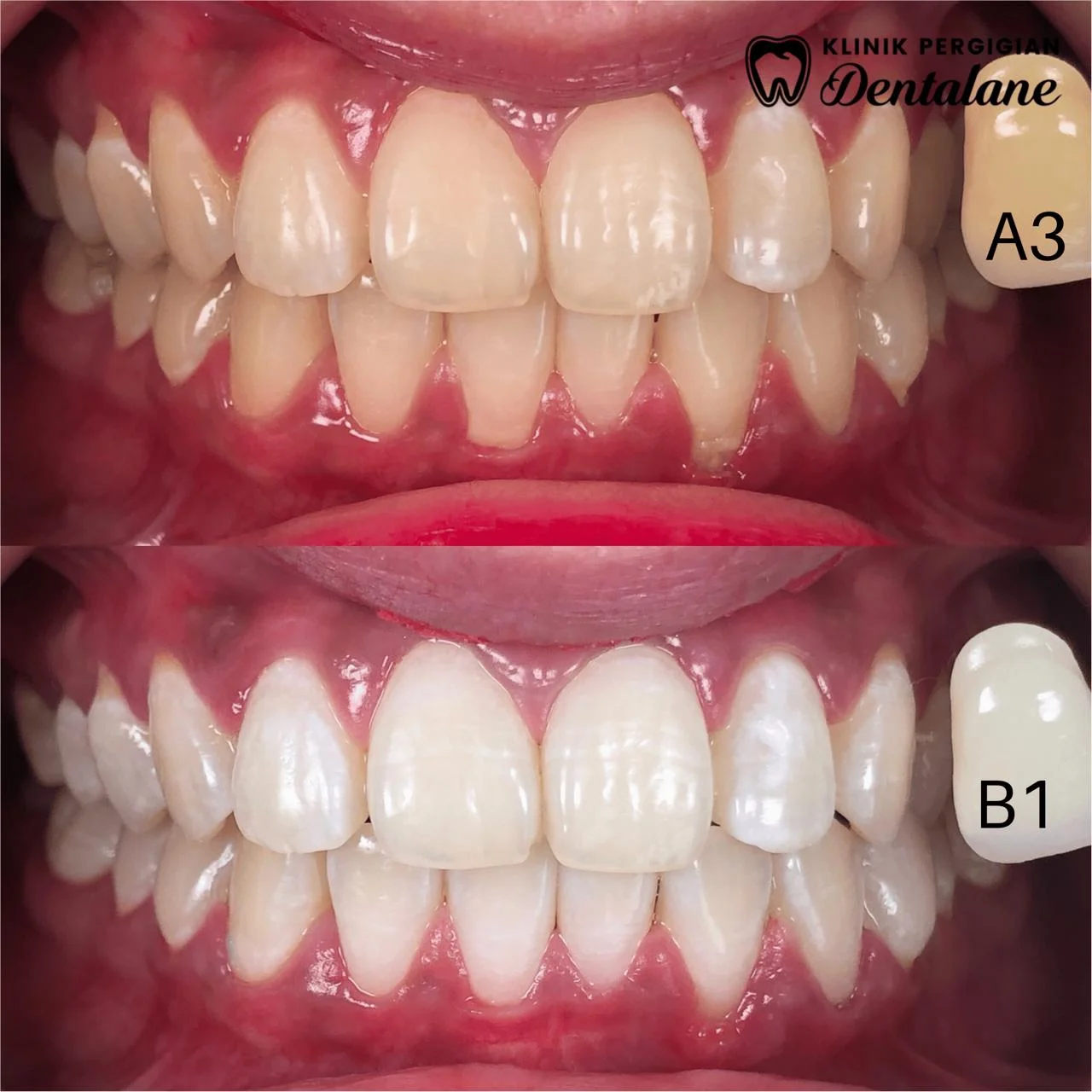 Gigi sebelum dan selepas whitening, kes 3